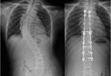 Scoliosis