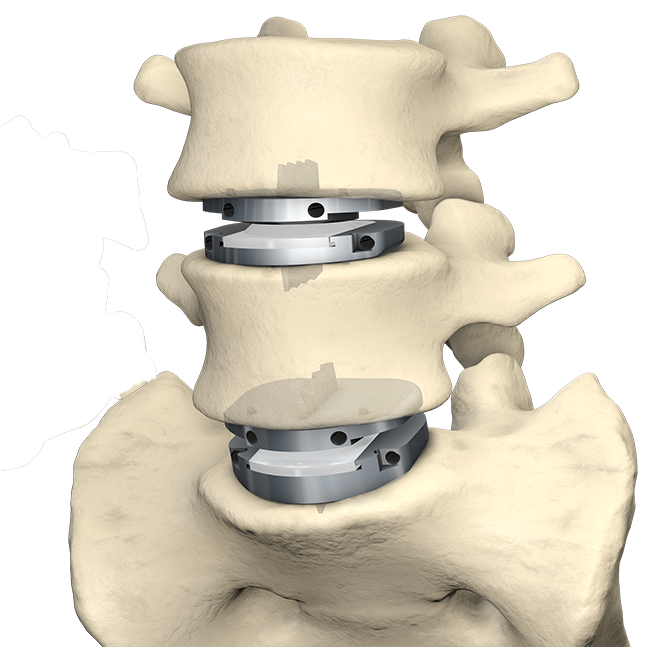 Lumbar Artificial Disc Replacement